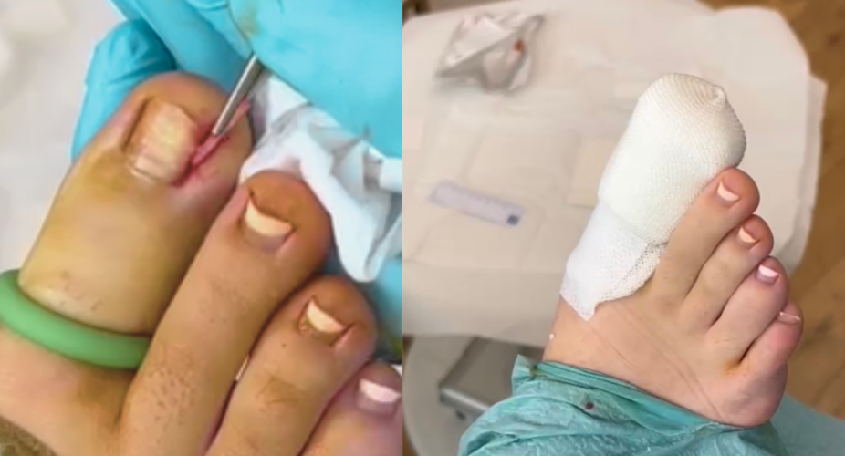 The Ultimate Guide to Ingrown Toenails: Understanding, Prevention, and Treatment