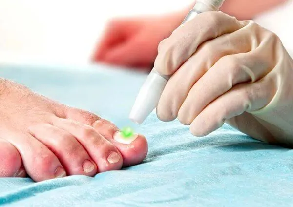 Laser Treatment For Fungal Nails