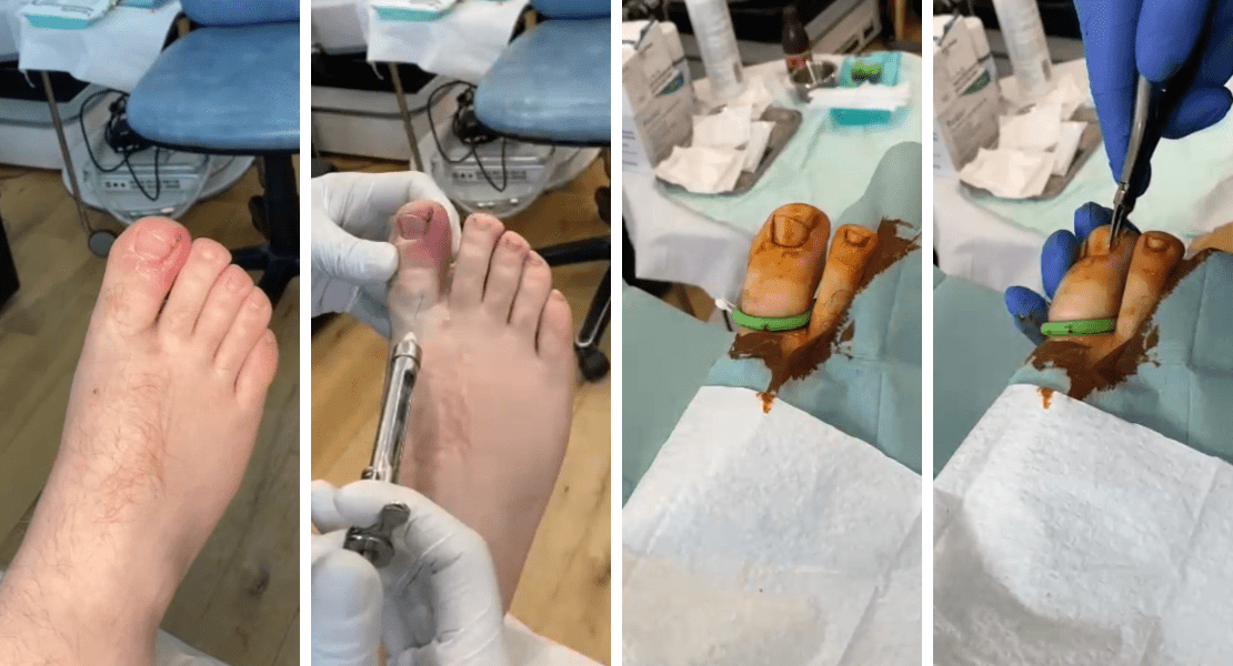 Stage of ingrowing toenail removal