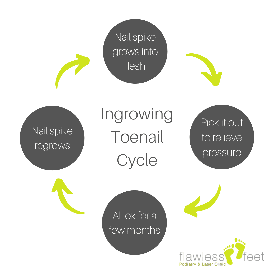 cycle of ingrowing toenail