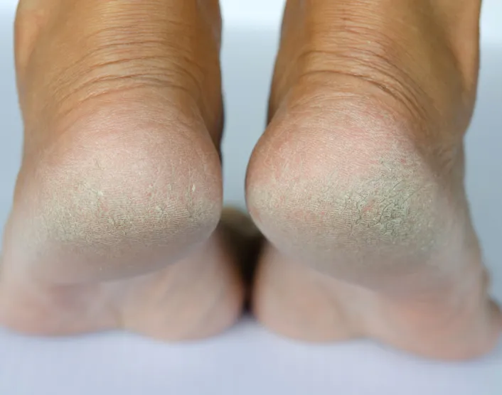 Understanding Corns and Calluses on Feet: Causes, Prevention, and Treatment