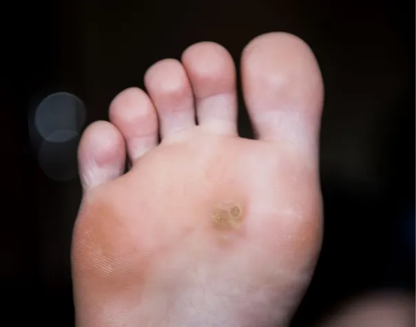 Understanding Corns and Calluses on Feet: Causes, Prevention, and Treatment