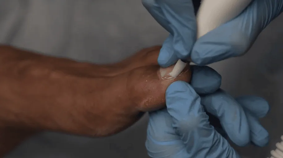 thickened, discoloured, or brittle nails