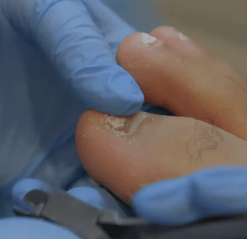 thickened, discoloured, or brittle nails