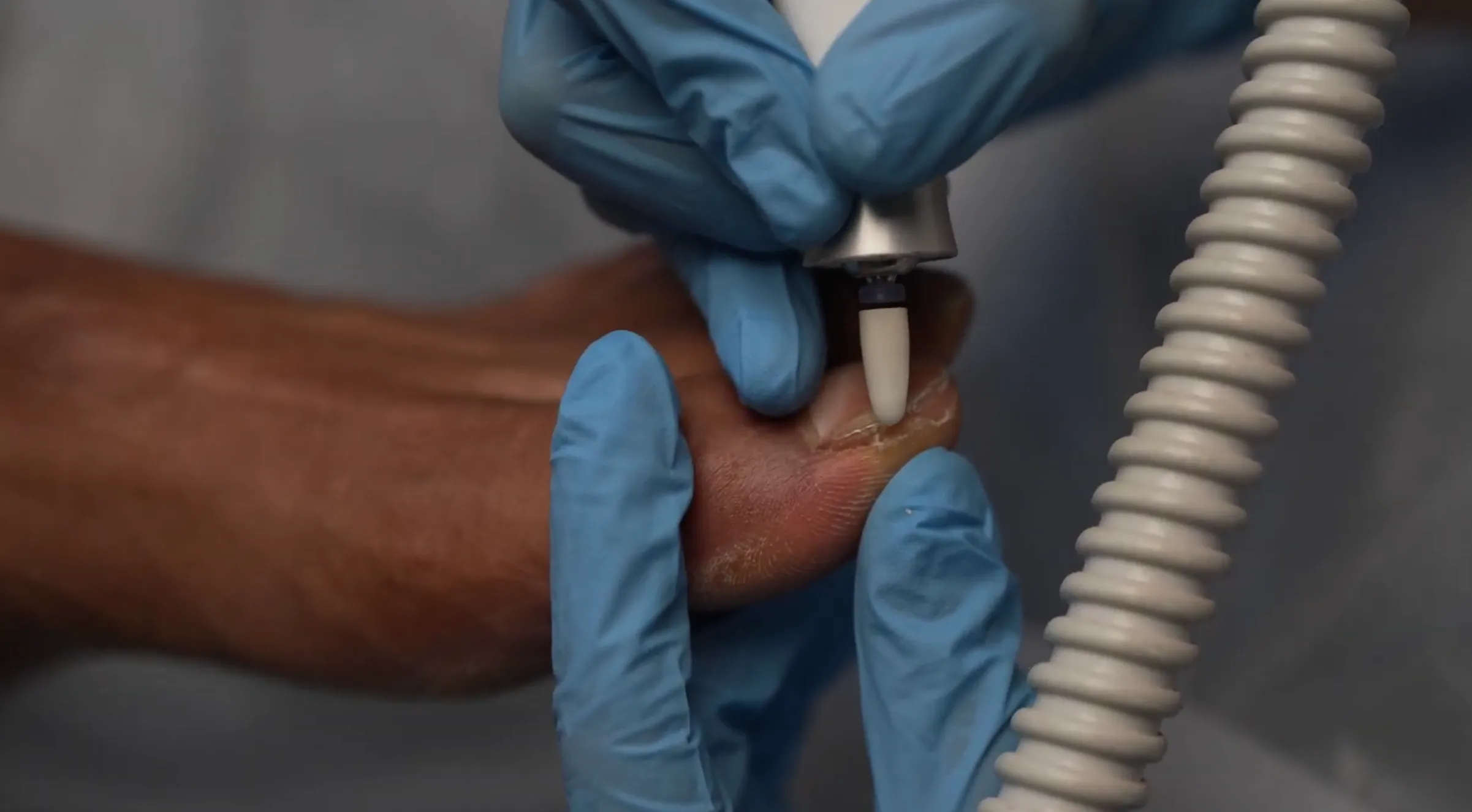 thickened, discoloured, or brittle nails