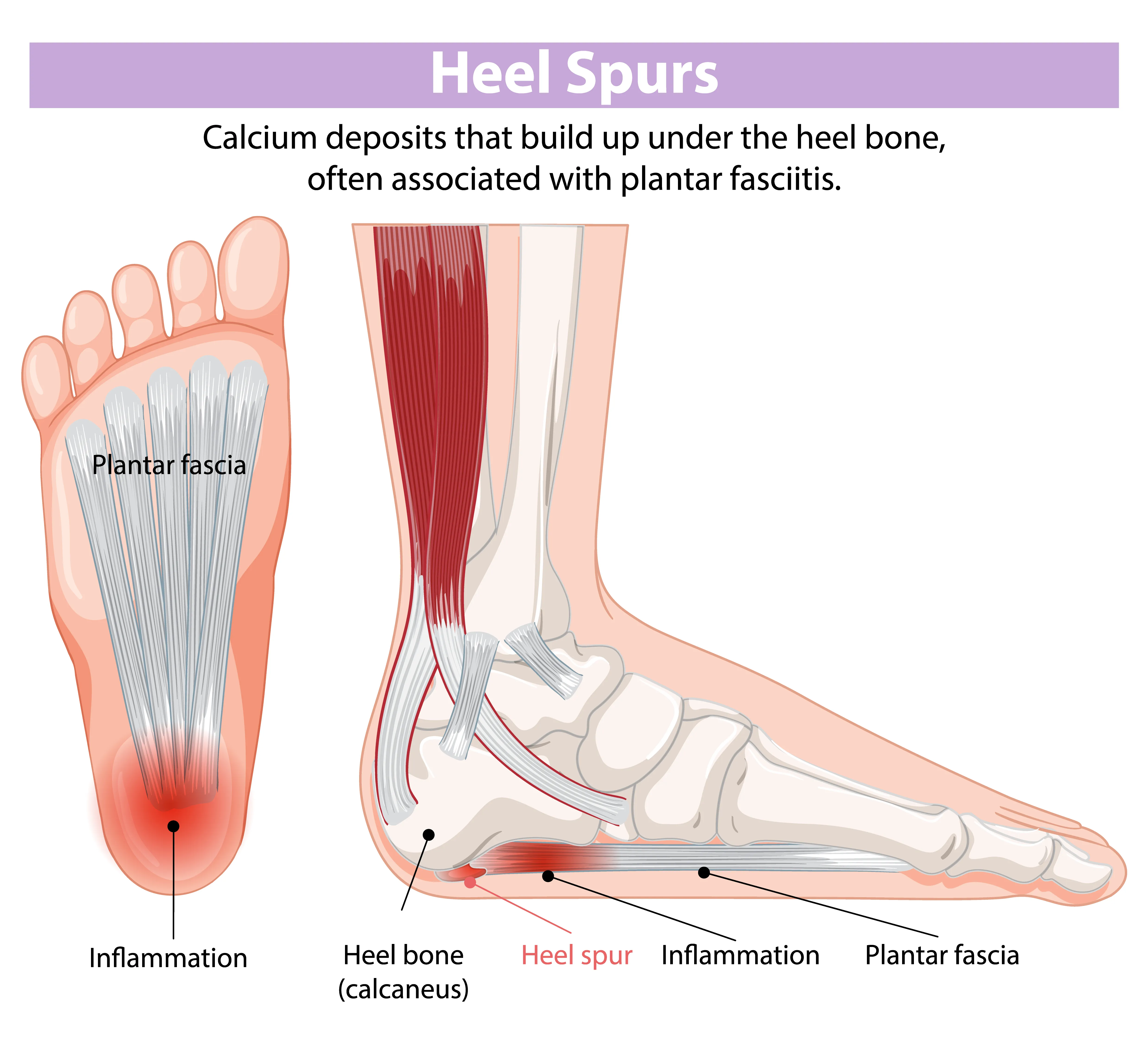 Heel Spur: Causes, Symptoms & Treatment Options in London