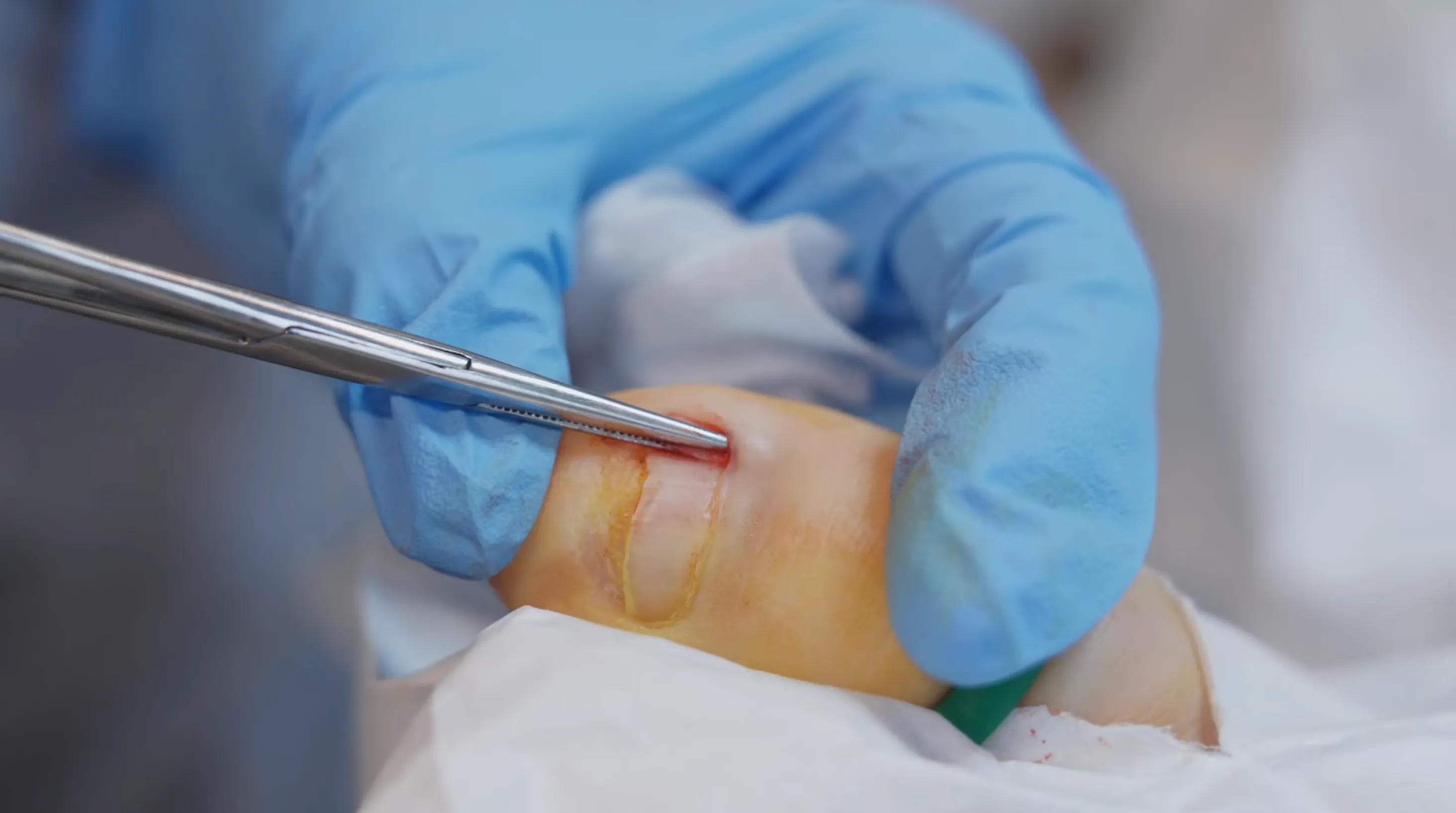 Ingrown Toenail (Onychocryptosis) – Symptoms, Causes & Diagnosis