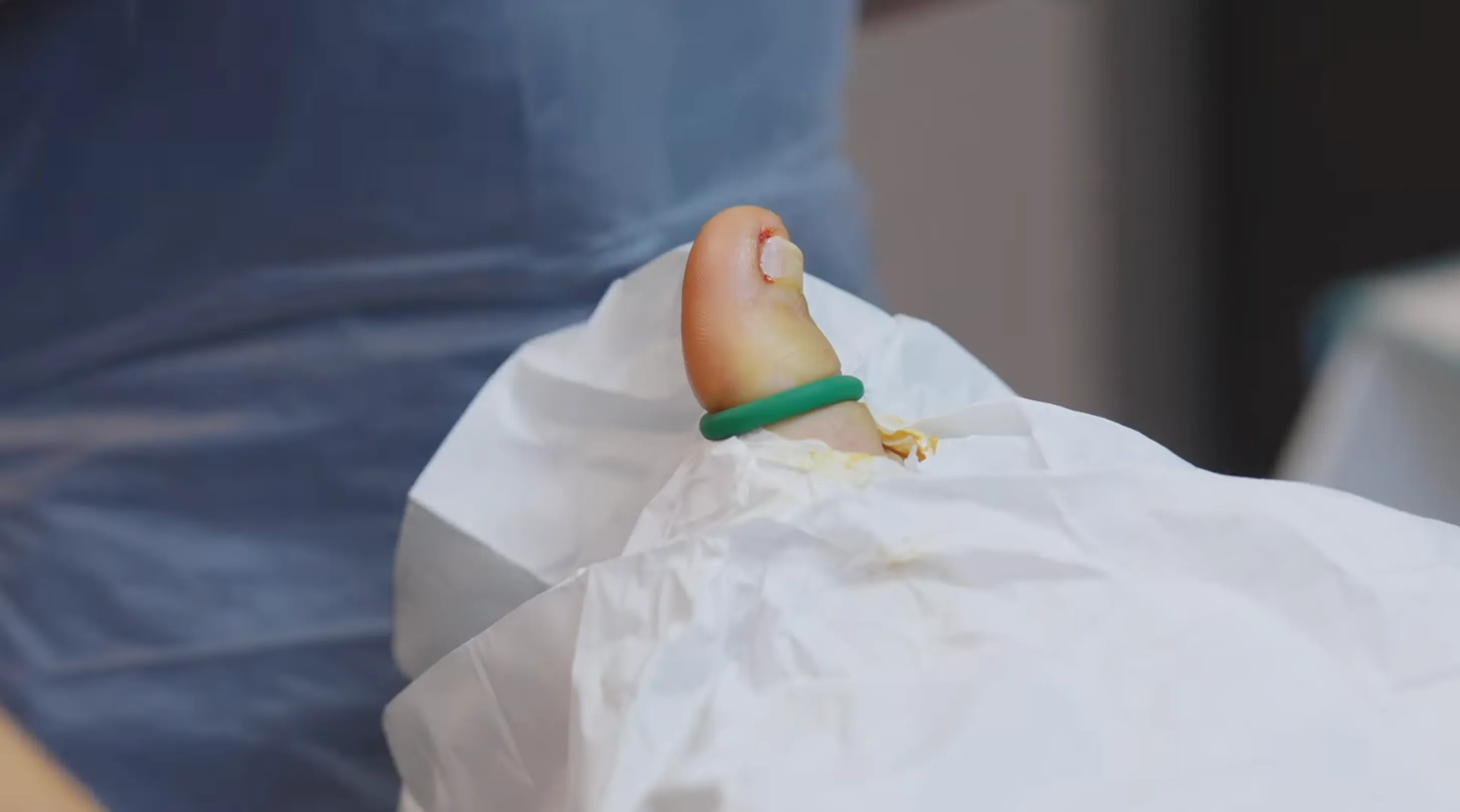 Ingrown Toenail (Onychocryptosis) – Symptoms, Causes & Diagnosis