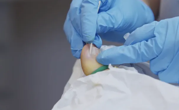 Ingrown Toenail (Onychocryptosis) – Symptoms, Causes & Diagnosis