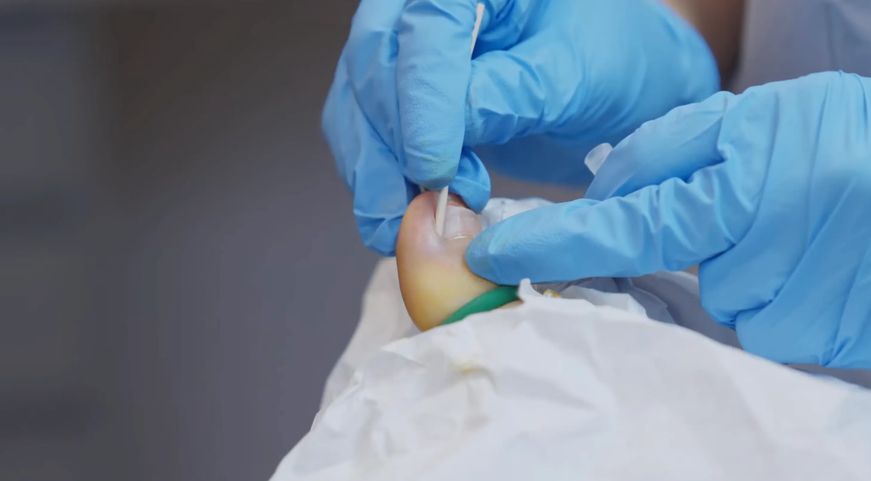Ingrown Toenail (Onychocryptosis) – Symptoms, Causes & Diagnosis