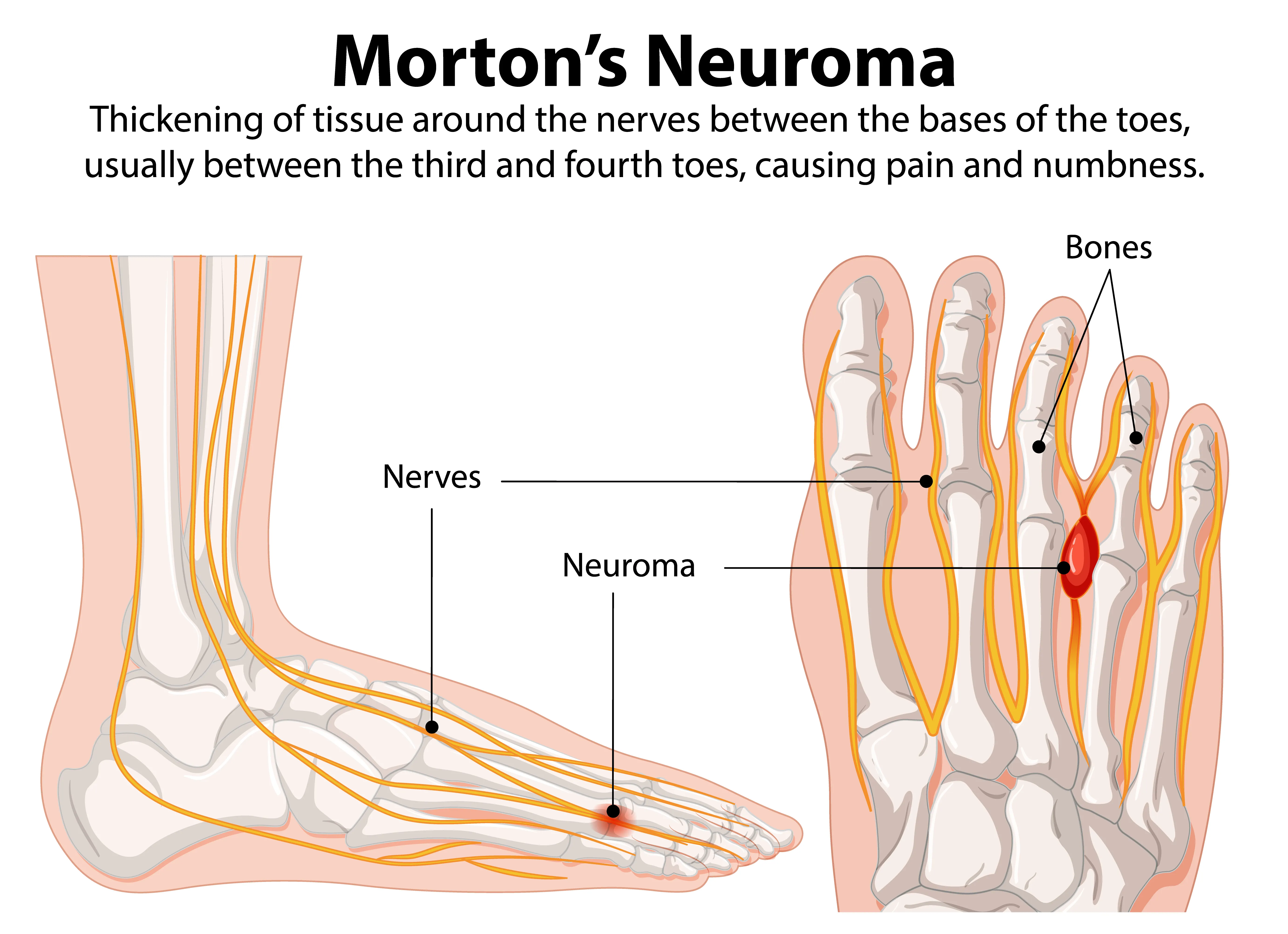 Morton's Neuroma