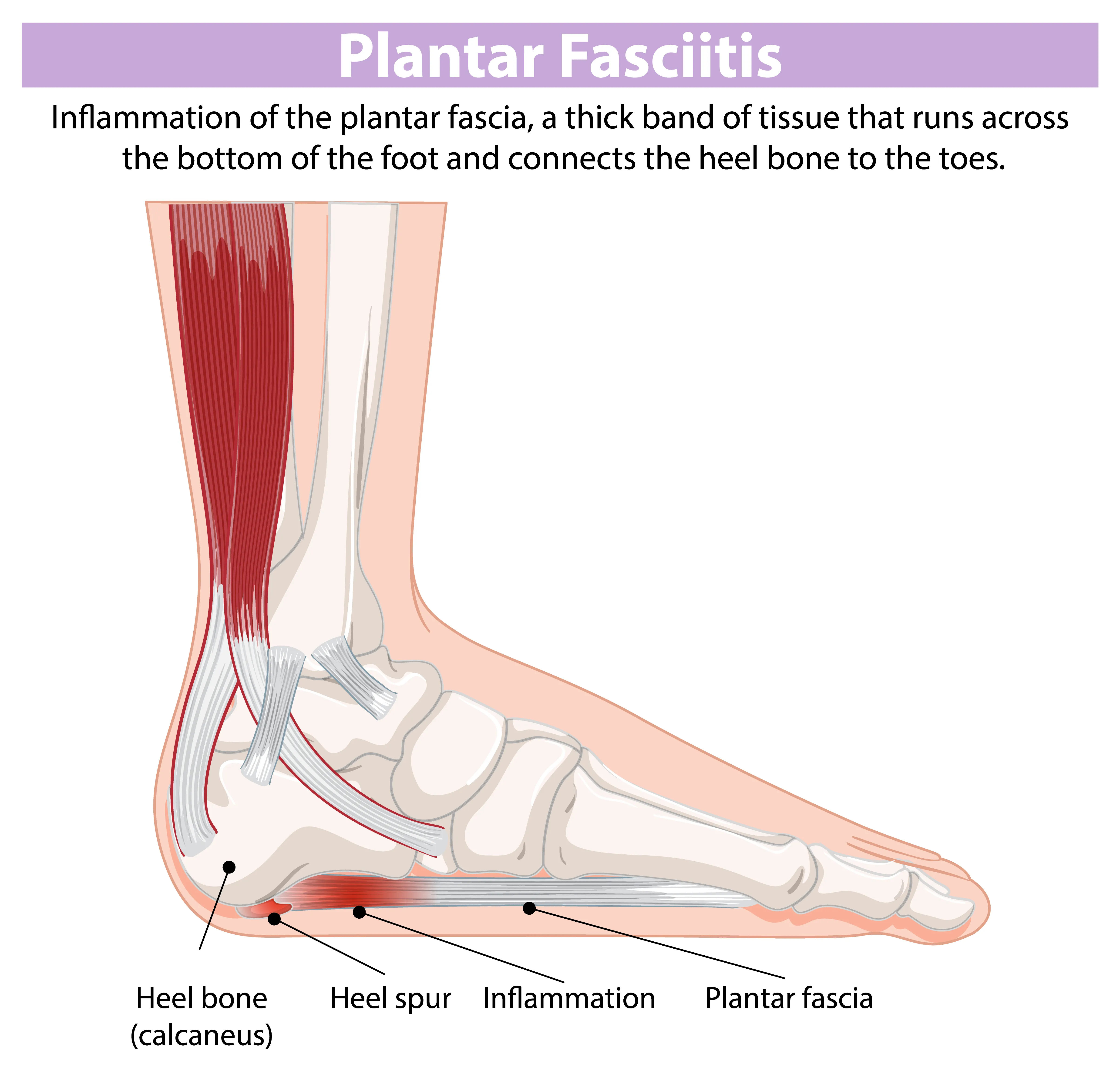 Plantar Fasciitis 