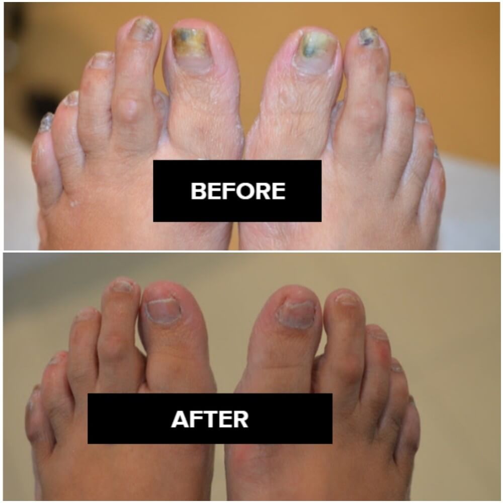 Laser Nail Fungal Treatment Toenail Fungus Removal London