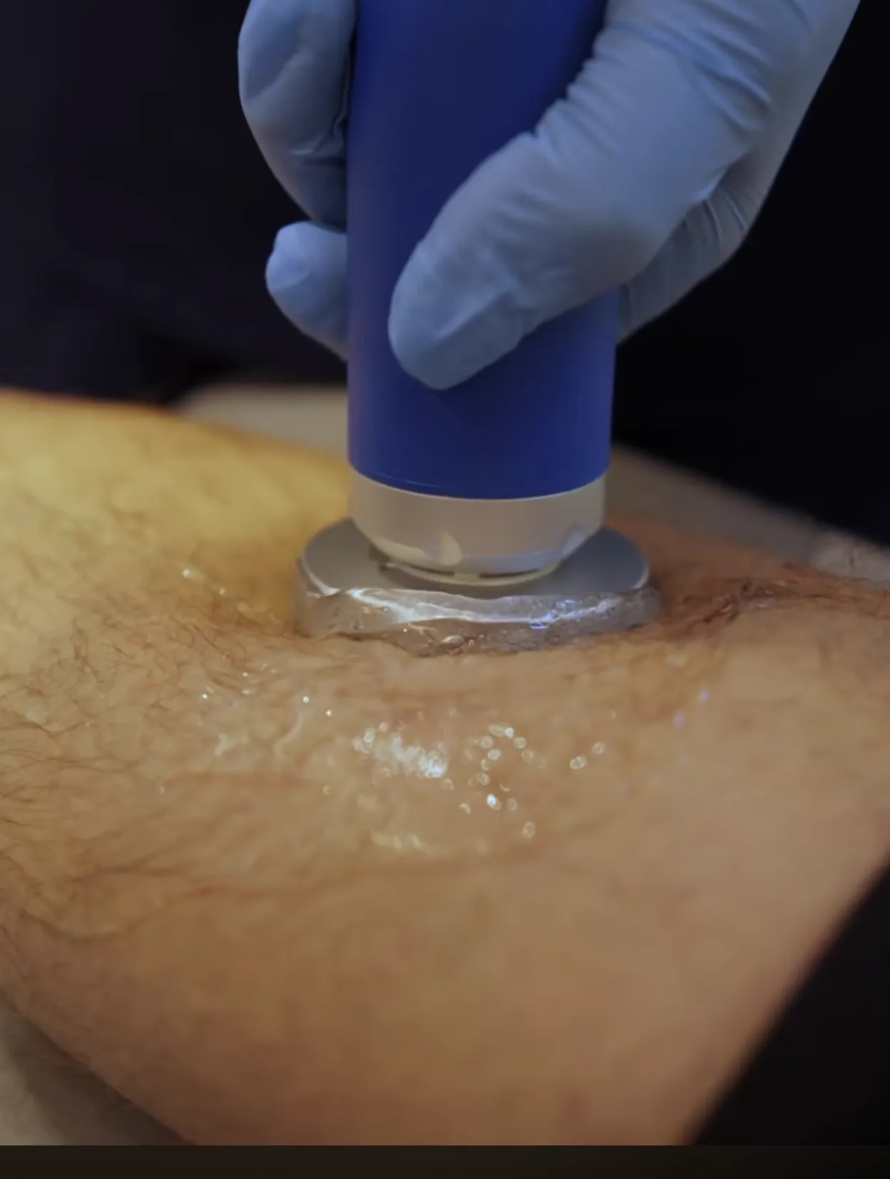 Does Shockwave Therapy Promote Healing