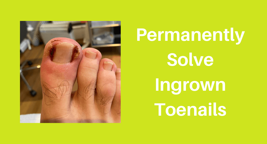 Ingrown Toenail for Westbank, Marrero, LA | Foot and Ankle Center, LLC |  Podiatrists & Foot and Ankle Surgeons