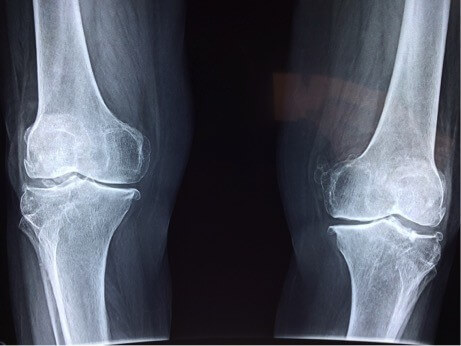 Feet, Orthotics and Knee Arthritis