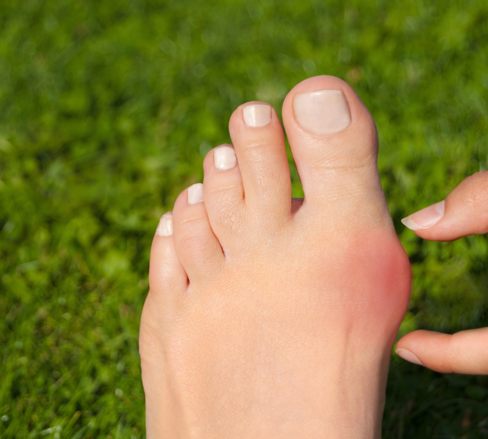 I’ve noticed a bunion is forming; what should I do?