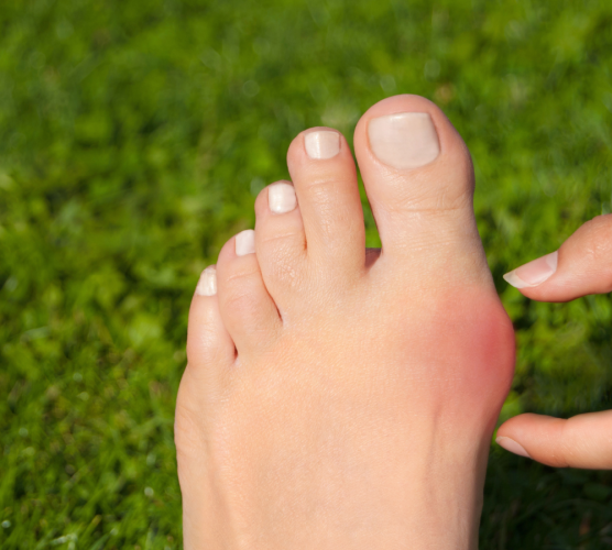 I’ve noticed a bunion is forming; what should I do?