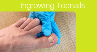 7 Causes of Ingrown Toenails