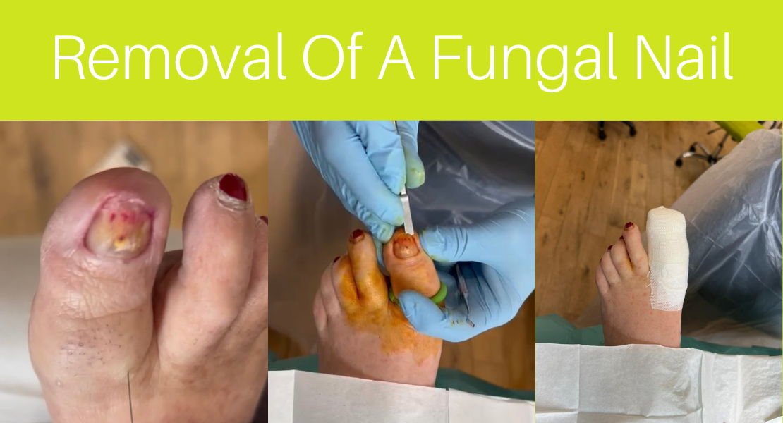 Story of a fungal nail removal
