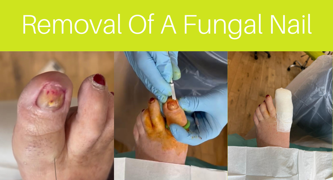 Fingernail Fungus from Acrylic Nails: Causes, Treatment, More