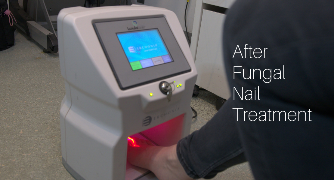Advice For After Laser Fungal Treatment