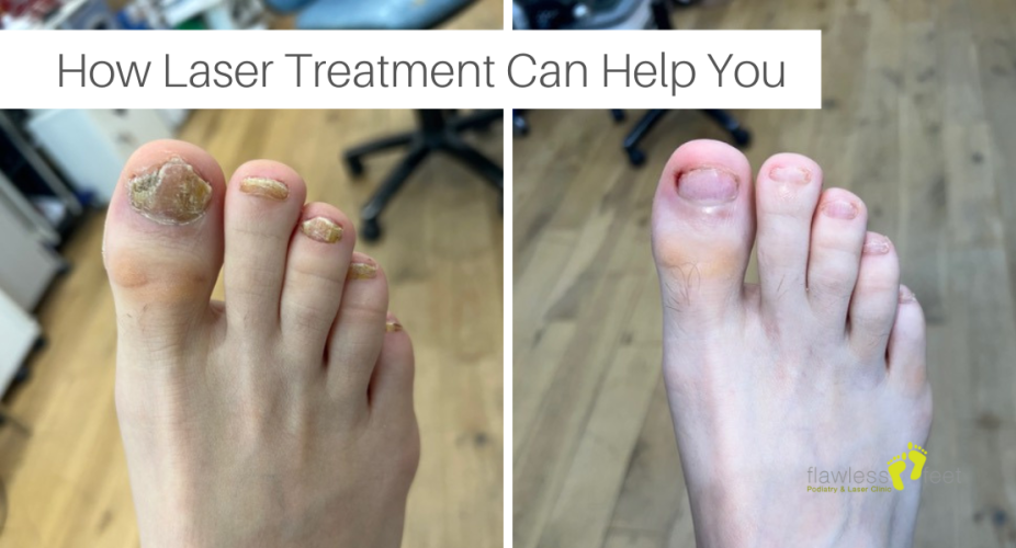 Say Goodbye to Fungal Nails: How Laser Treatment Can Help You
