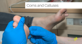 Understanding Corns and Calluses on Feet: Causes, Prevention, and Treatment