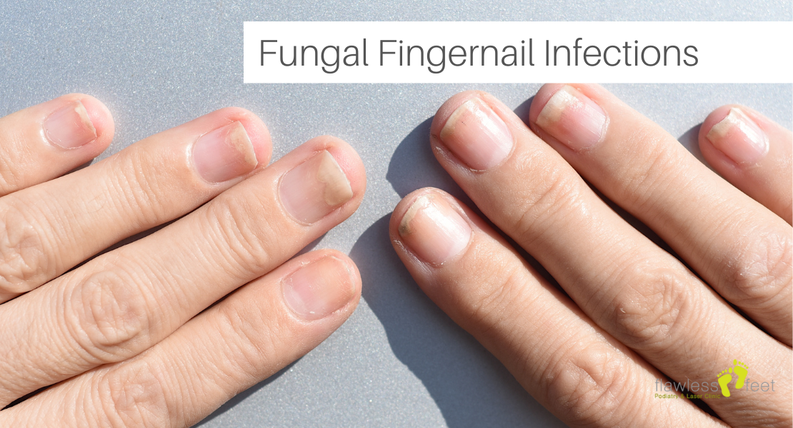 Fungal Fingernail Infections