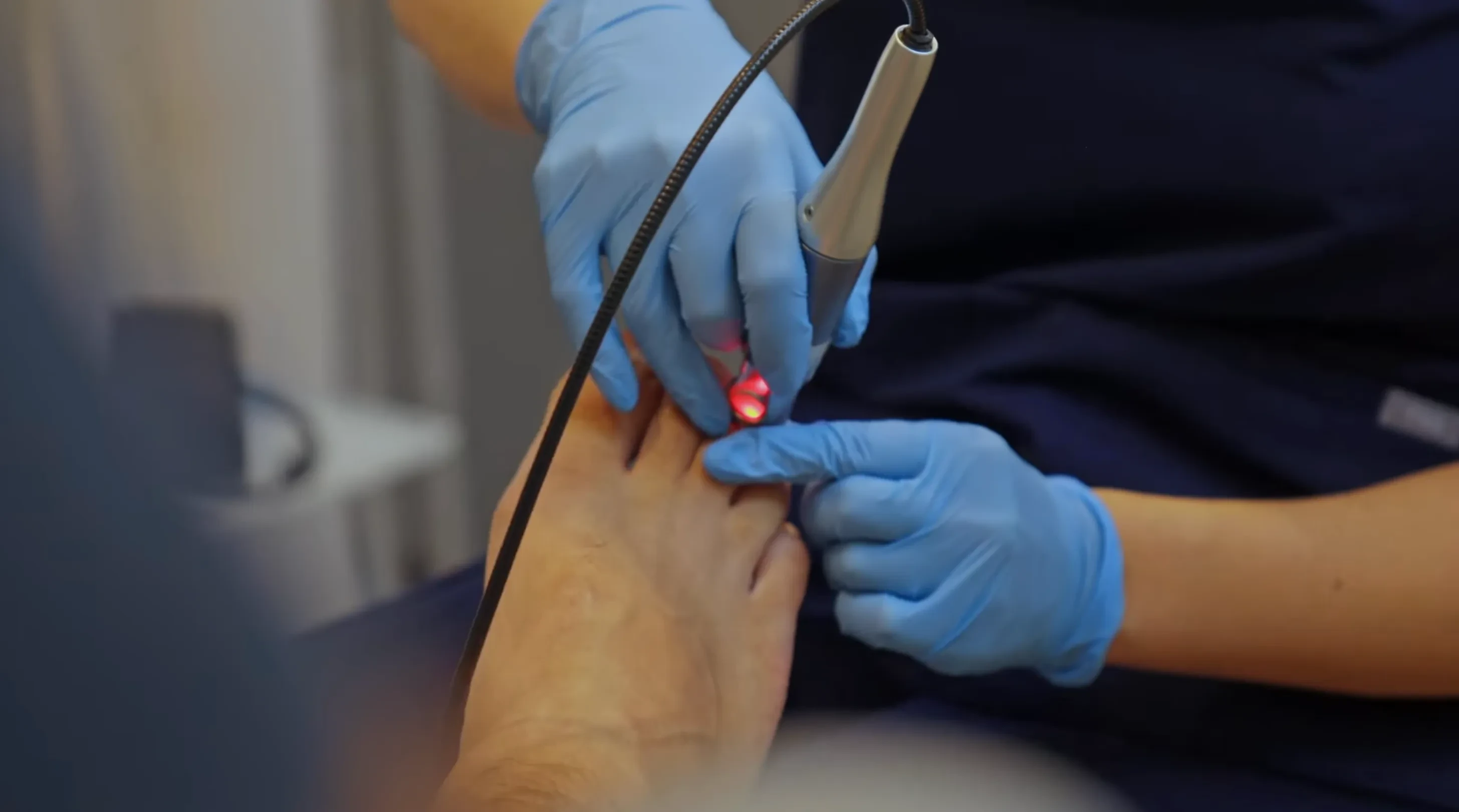 Does Laser Treatment Work for Fungal Nails?